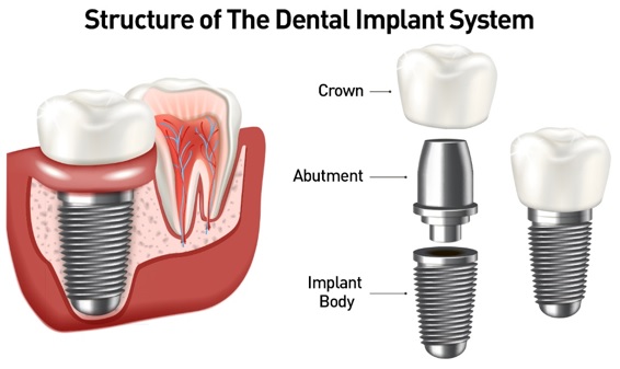 a dental implant system