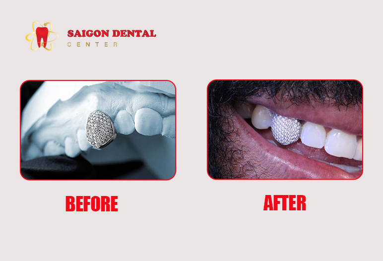 before after diamond teeth image