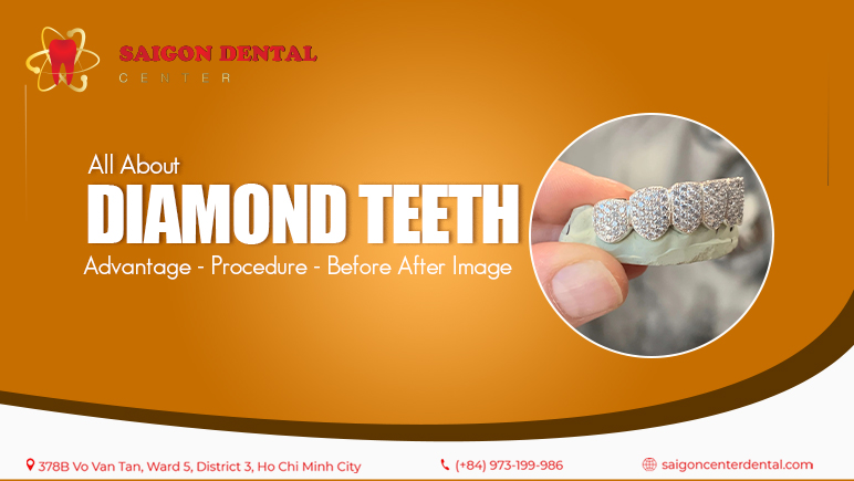 diamond teeth in ho chi minh city