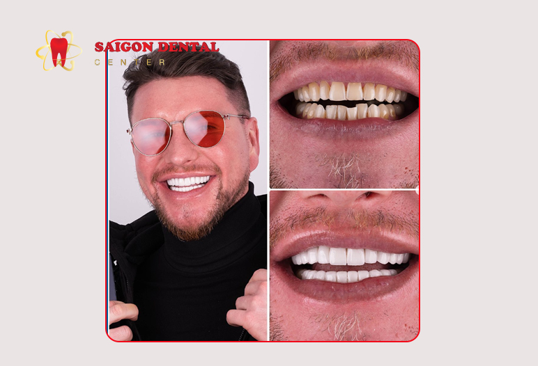 hollywood smile before after image