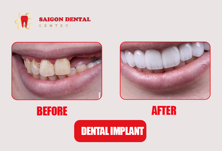 Dental Implant