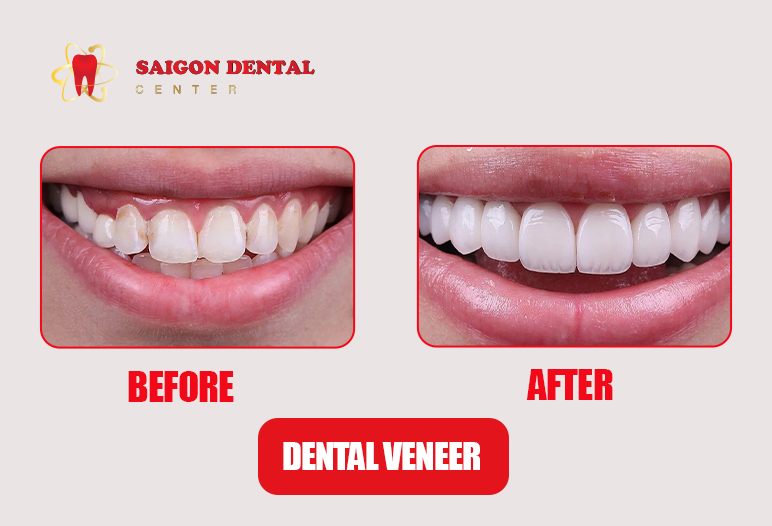 veneer before after