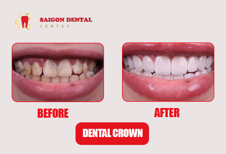 dental veneer before after