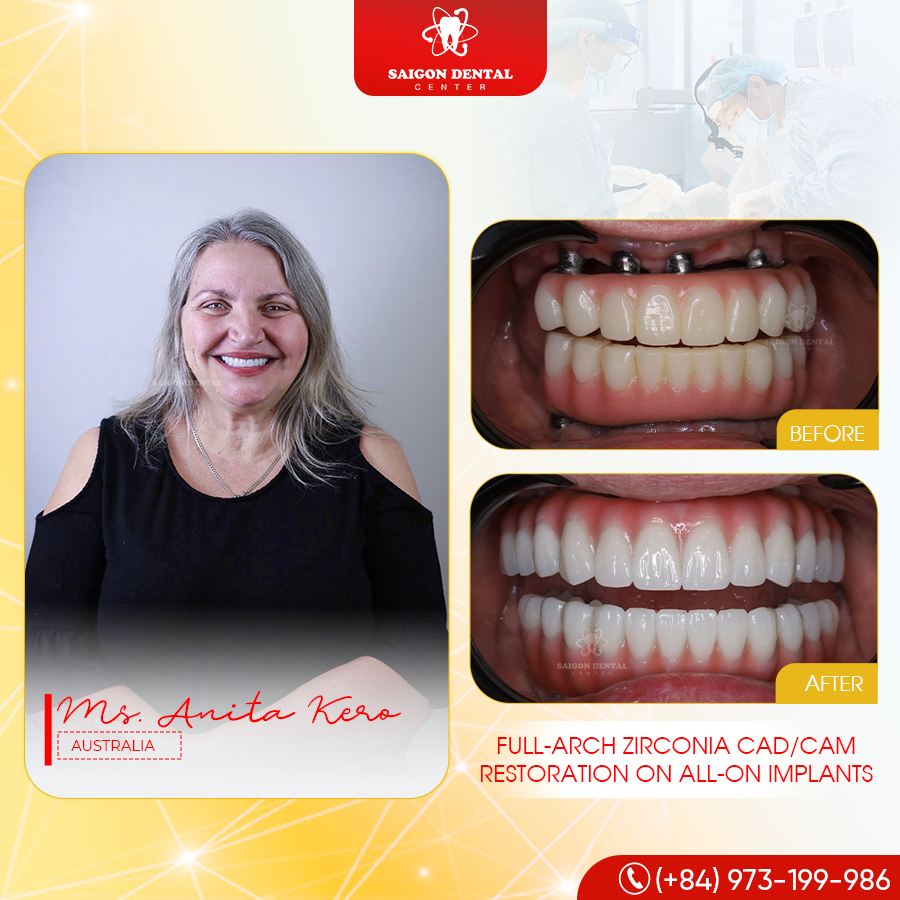 permanet teeth Permanent teeth