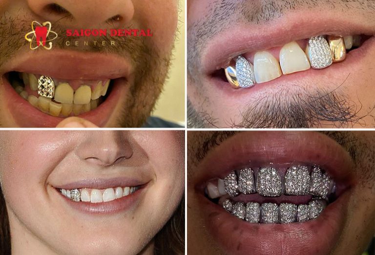 All About Diamond Teeth Advantage Procedure Before After Image