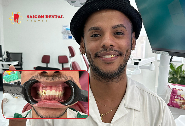 gold teeth before after image