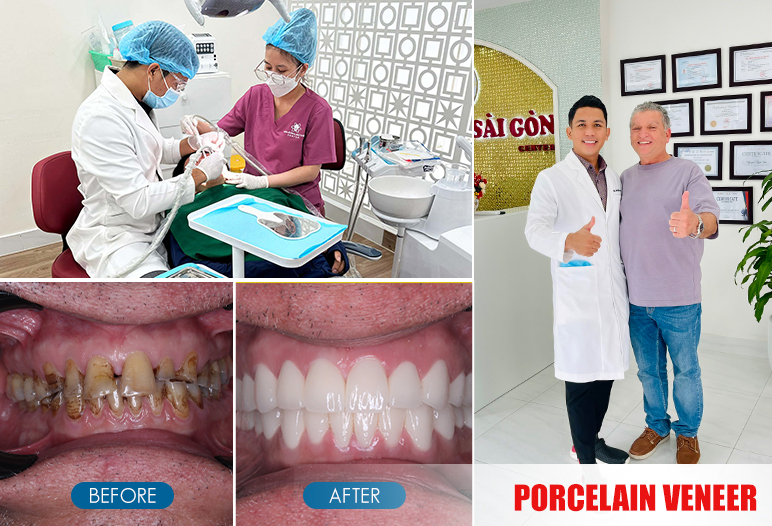 porcelain veneer before and after image