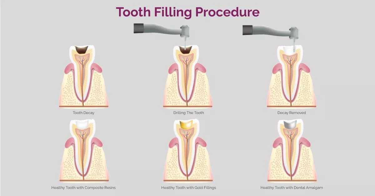 procedure for treating cavities