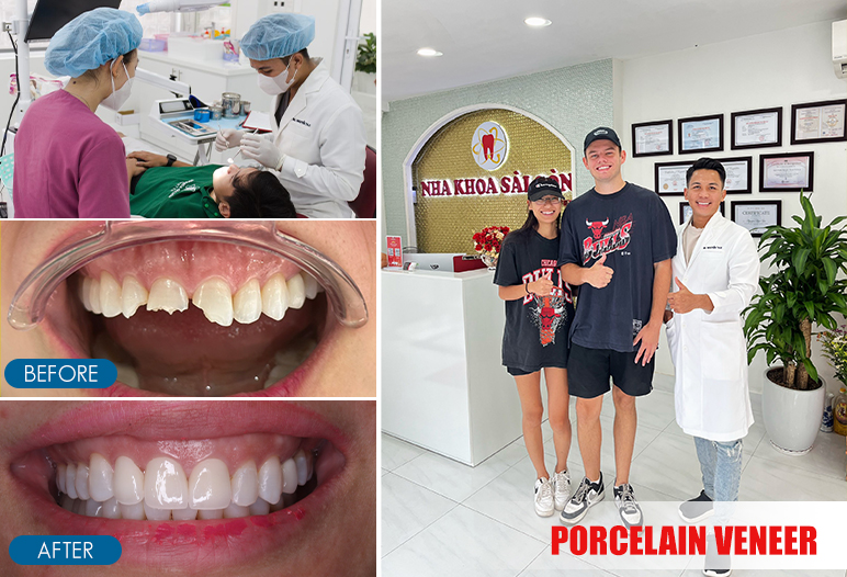 porcelain veneer before and after image