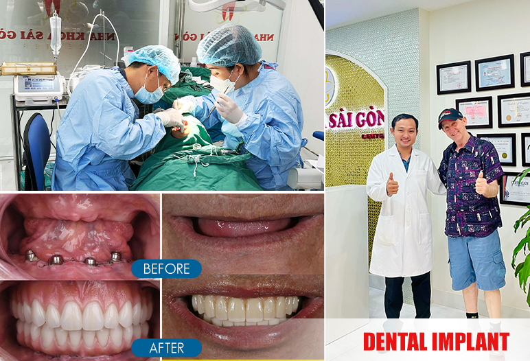 Dental implants 