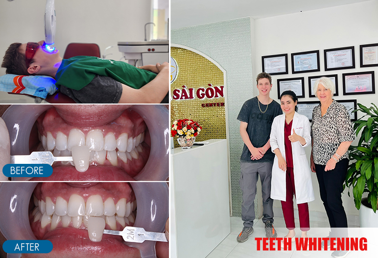 To get tooth filling in Vietnam