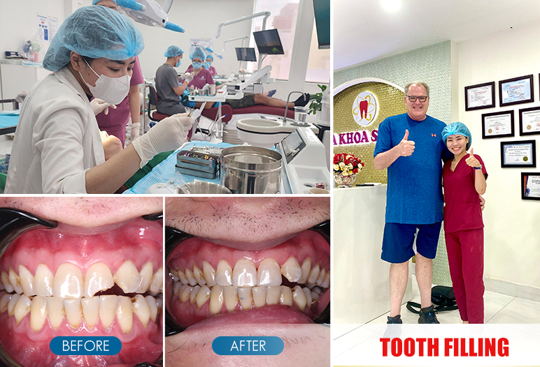 tooth filling before and after