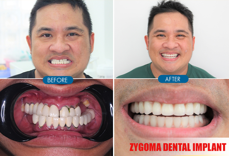 zygoma dental implant before after