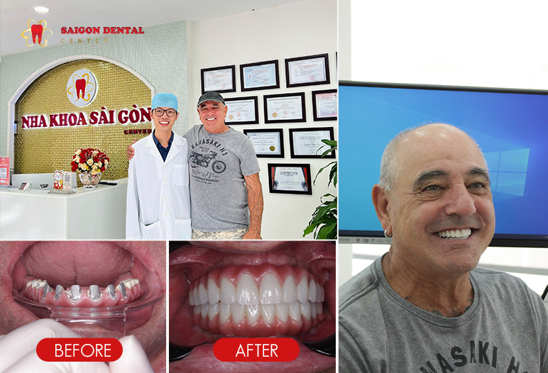 Before and After Dental Restoration Images