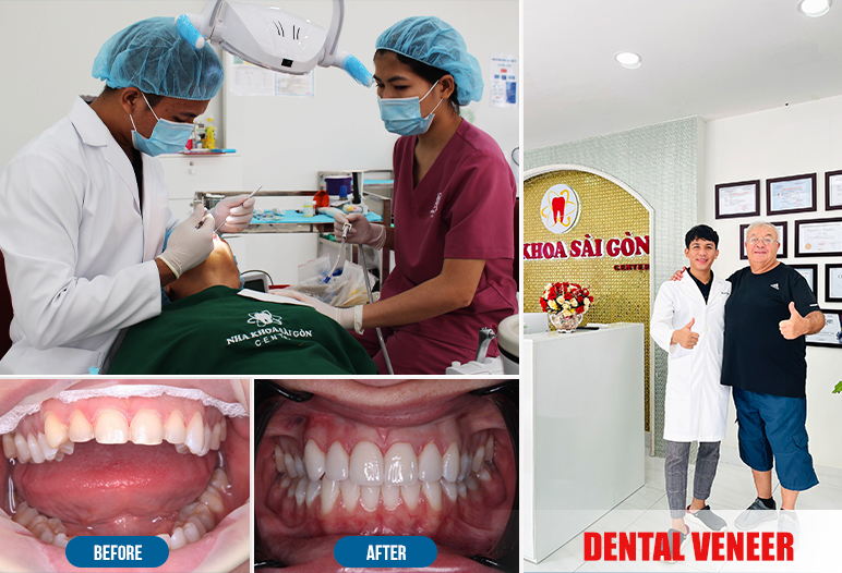 To get dental vener in Vietnam