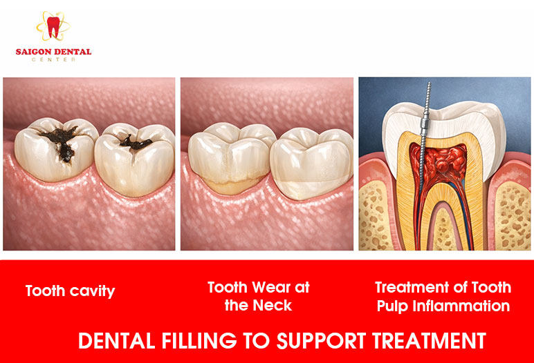 dental fillings