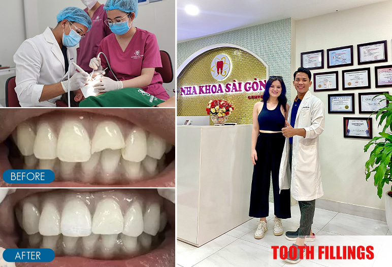 before after image dental fillings