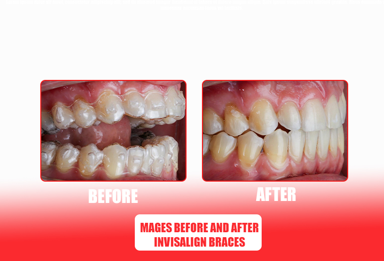 Image beforeand after invisalign braces