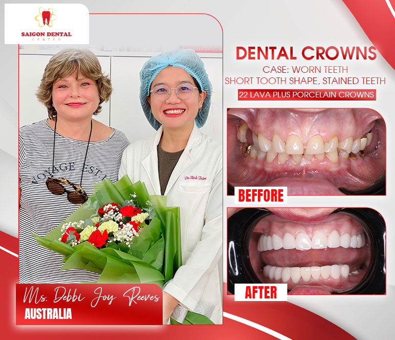 getting dental crowns