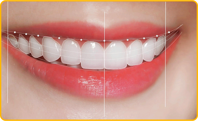 dental veneers design smile