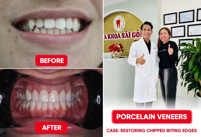 dental restoration