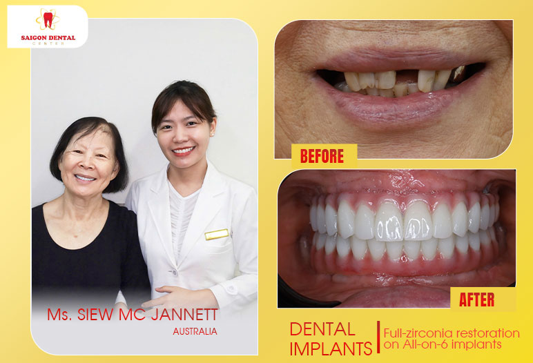 before after dental implants