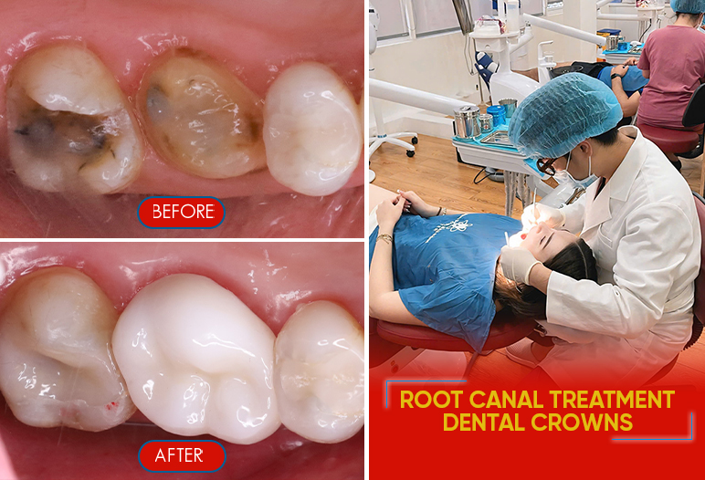 root canal treatment before after