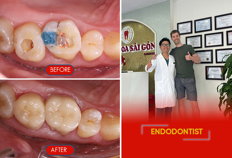 root canal treatment before after