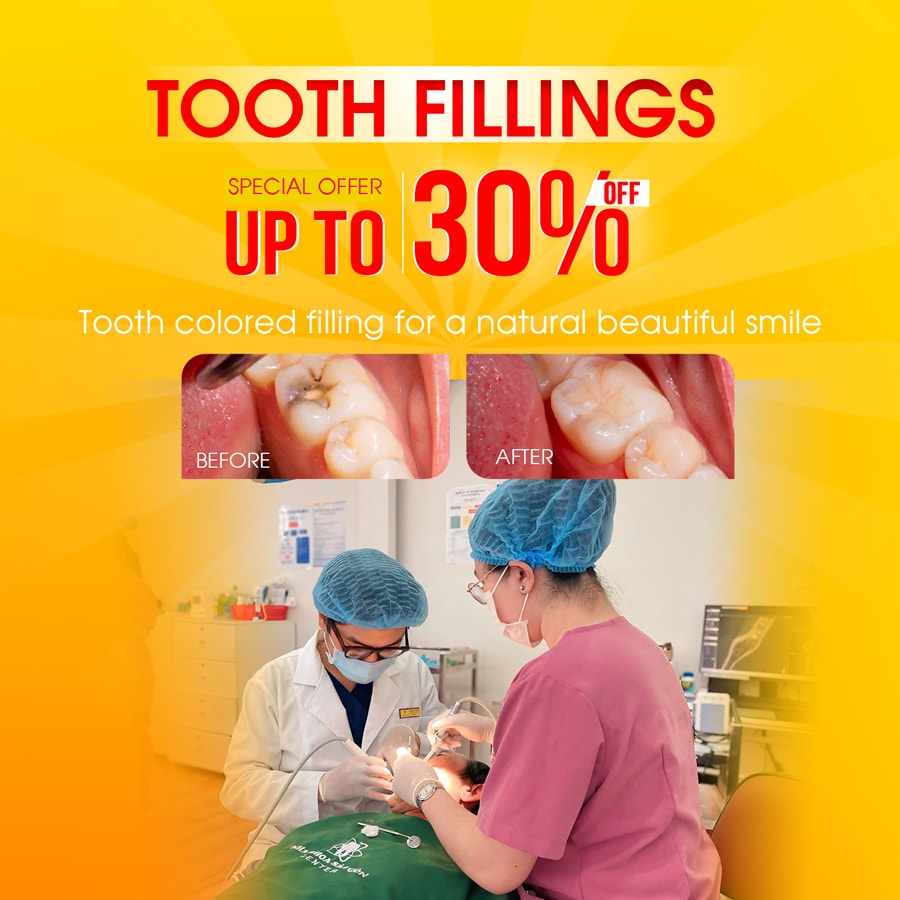 tooth fillings