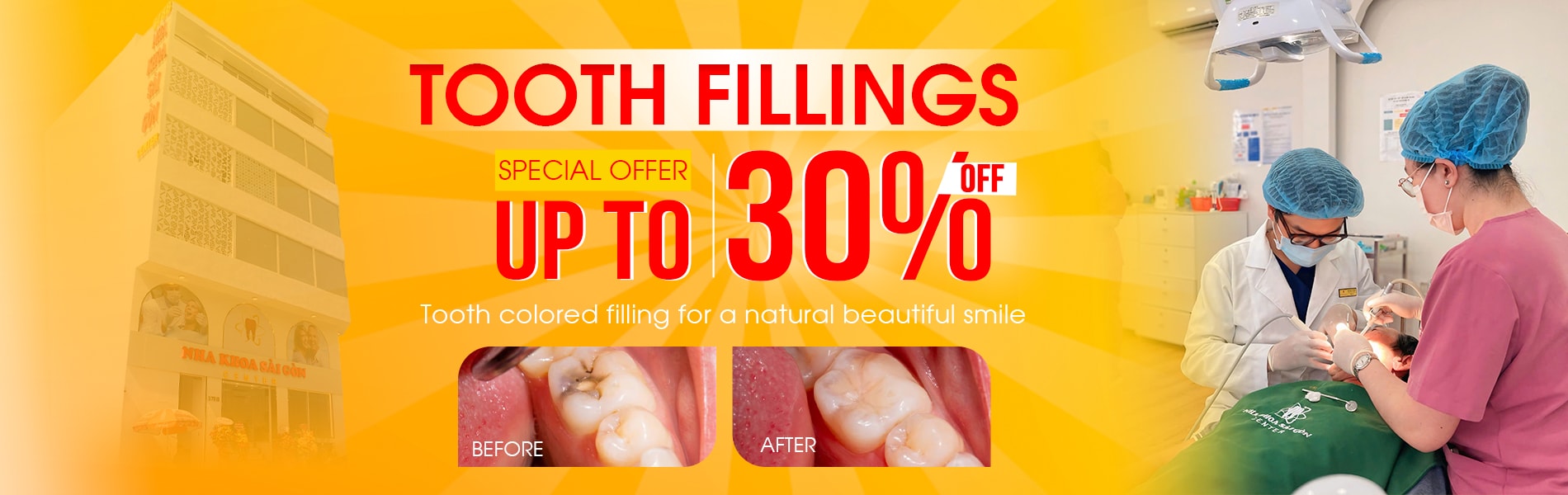 tooth fillings