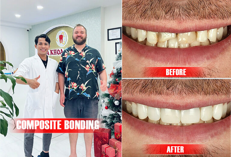 How Much Is Composite Bonding In Ho Chi Minh City Saigon Center How Much Is Composite Bonding In Ho Chi Minh City Saigon Center
