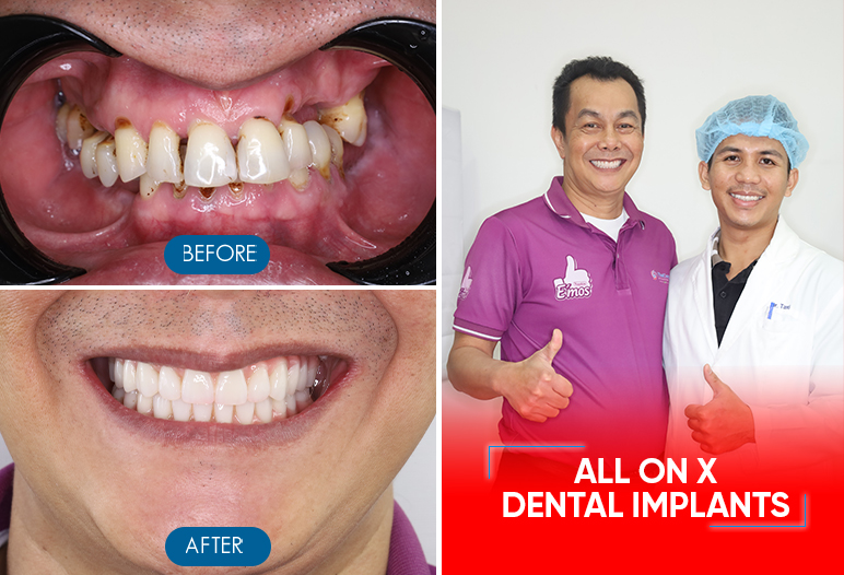 full mouth dental implants before after