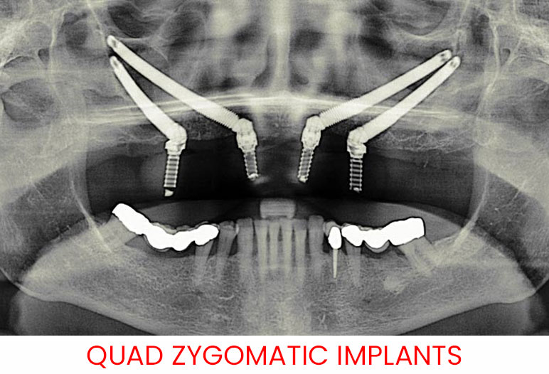 What Are Zygomatic Dental Implants Saigon Center Dental Clinic