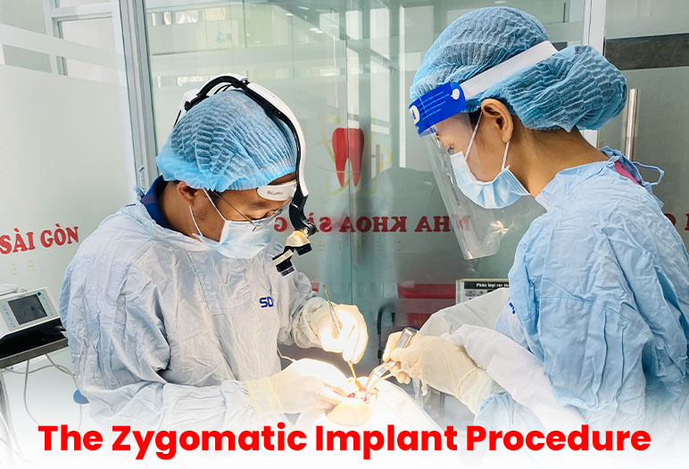 zygomatic dental implants