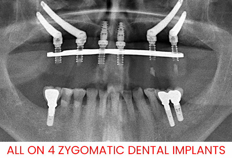 zygomatic dental implants