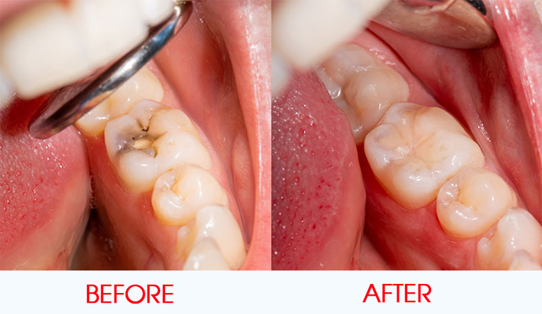 bulk filling composite before after