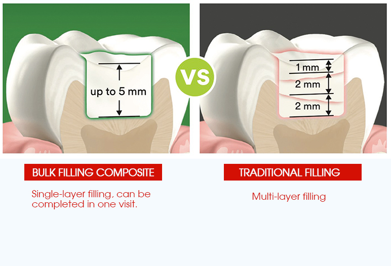 bulk fillings composite vs traditionail fillings