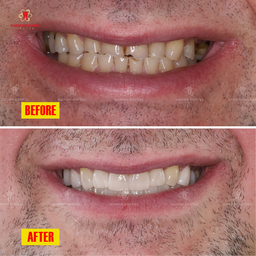 composite bonding 1 dental bonding