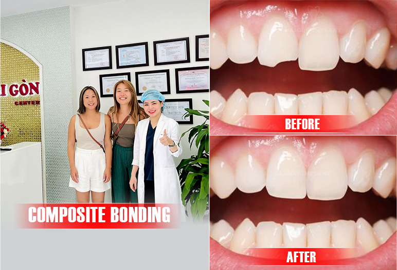 dental bonding front teeth