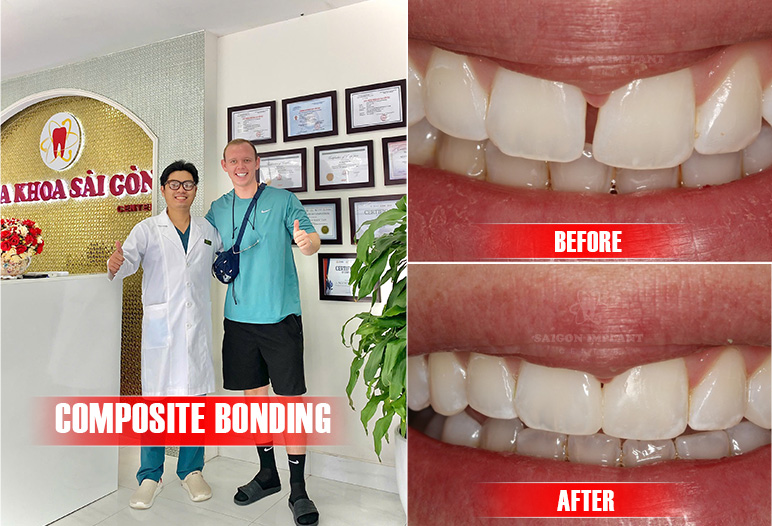 dental bonding for gaps