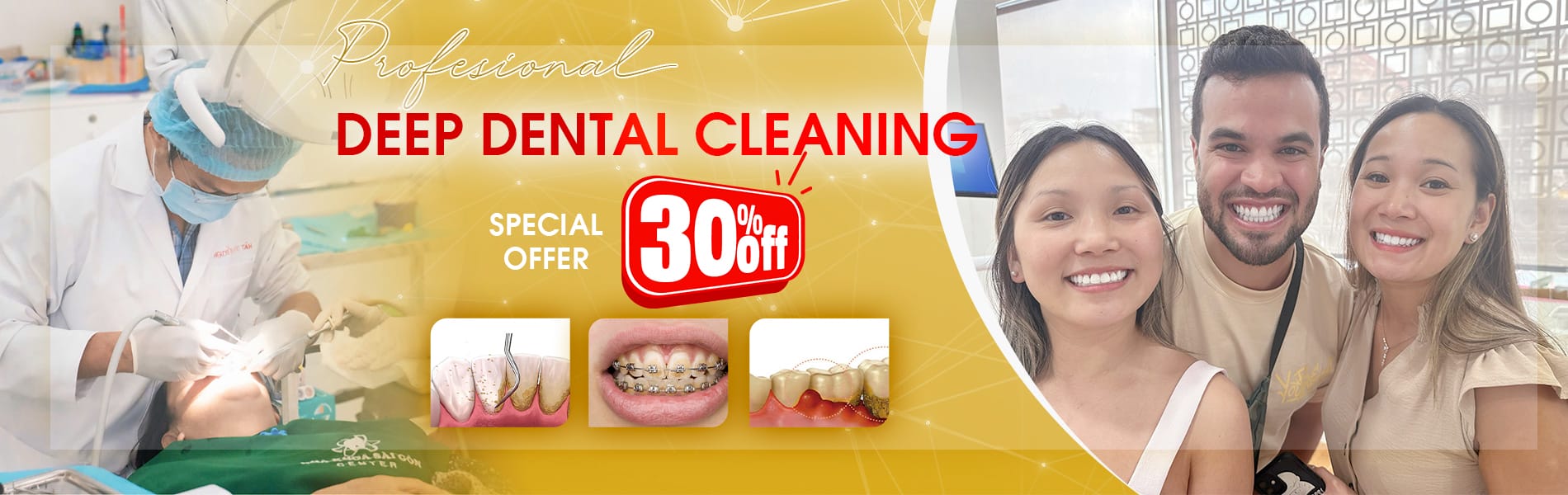 deep dental cleaning