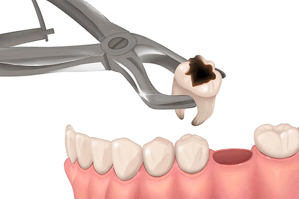 tooth extraction