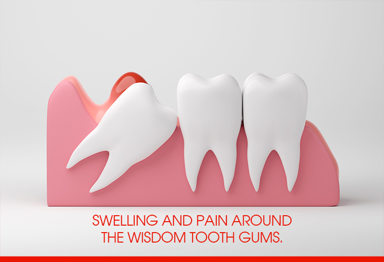 Symptoms of Wisdom Tooth Growing Pain