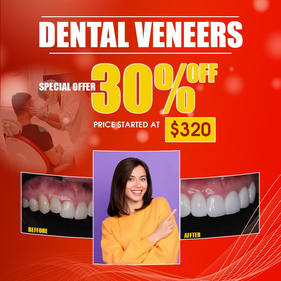 best dental veneers