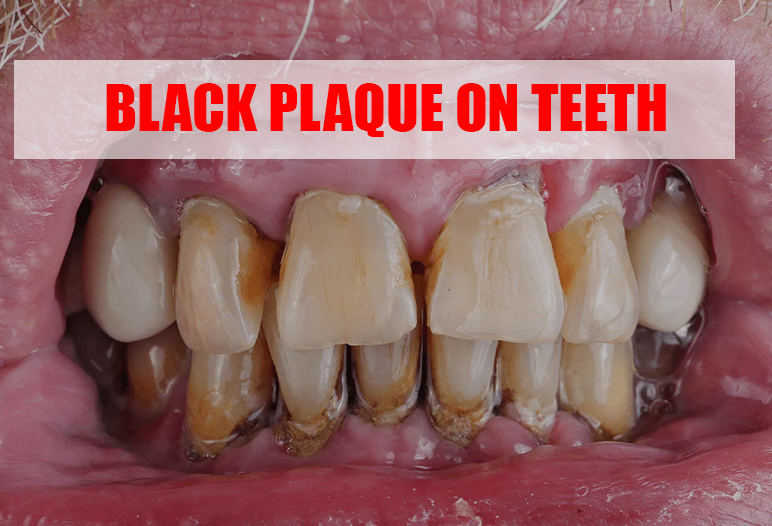 black tartar on gum line