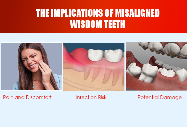 The implications of misaligned wisdom teeth