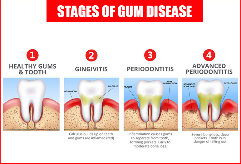 Stages of gum disease on one tooth