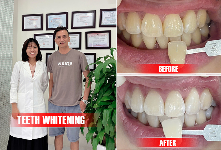 Teeth whitening before and after