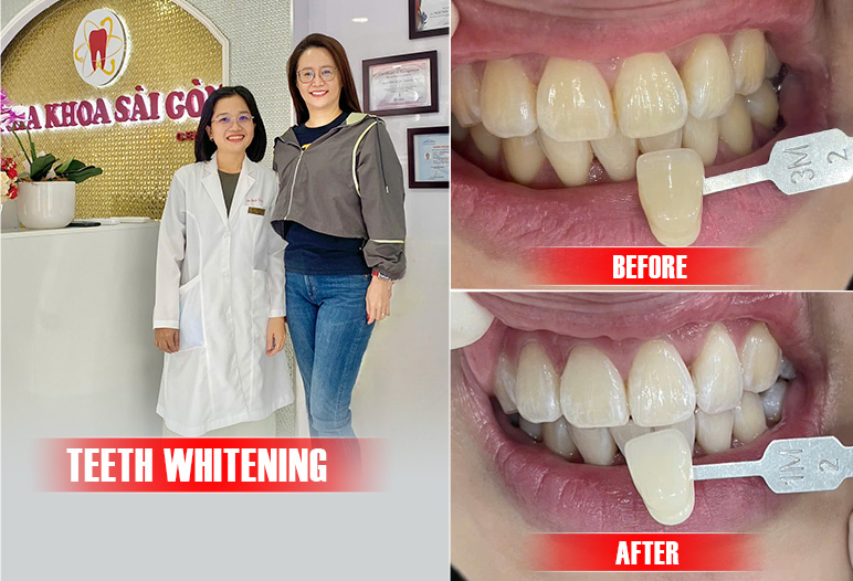 white teeth before after