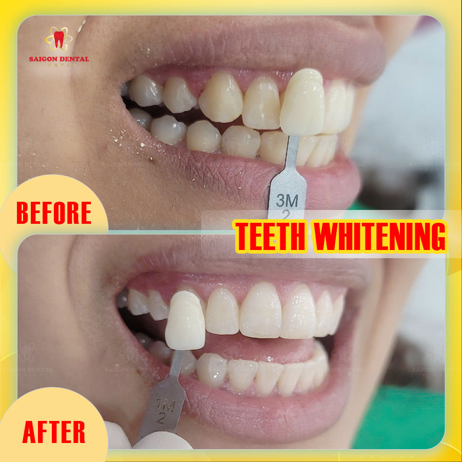 Teeth whitening hcmc 